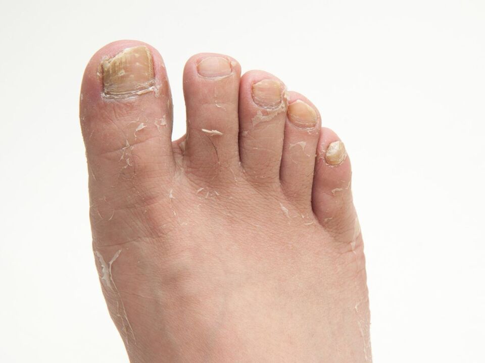 Fungo na pel das pernas e o seu tratamento con crema ZXCVBNMQWORT