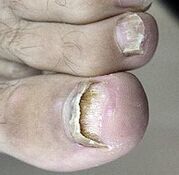 Lanzou o fungo das uñas