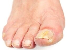 Fungo das uñas