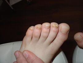 Onicomicosis