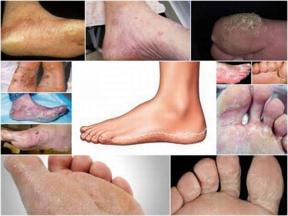 Forma escamosa-hiperqueratósica de micose dos pés