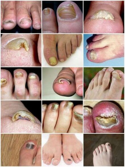 Infección fúngica da placa da unha do pé