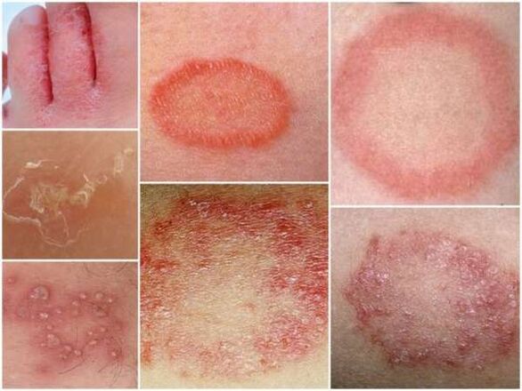 Tricofitose da pel das pernas