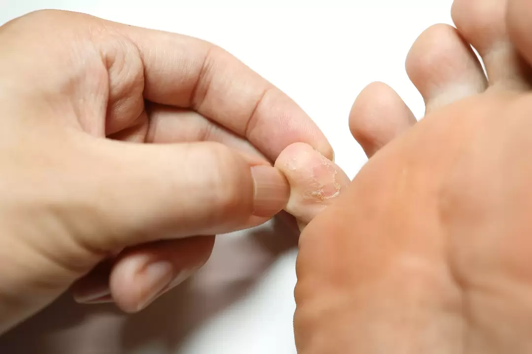 fungo nos dedos e o seu tratamento con crema de demyxil